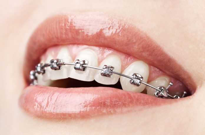 servicii-aparate-dentare-adulti-1000x658